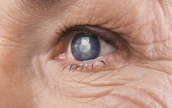 Glaucoma Diagnosis & Management - Kalispell Vision Clinic